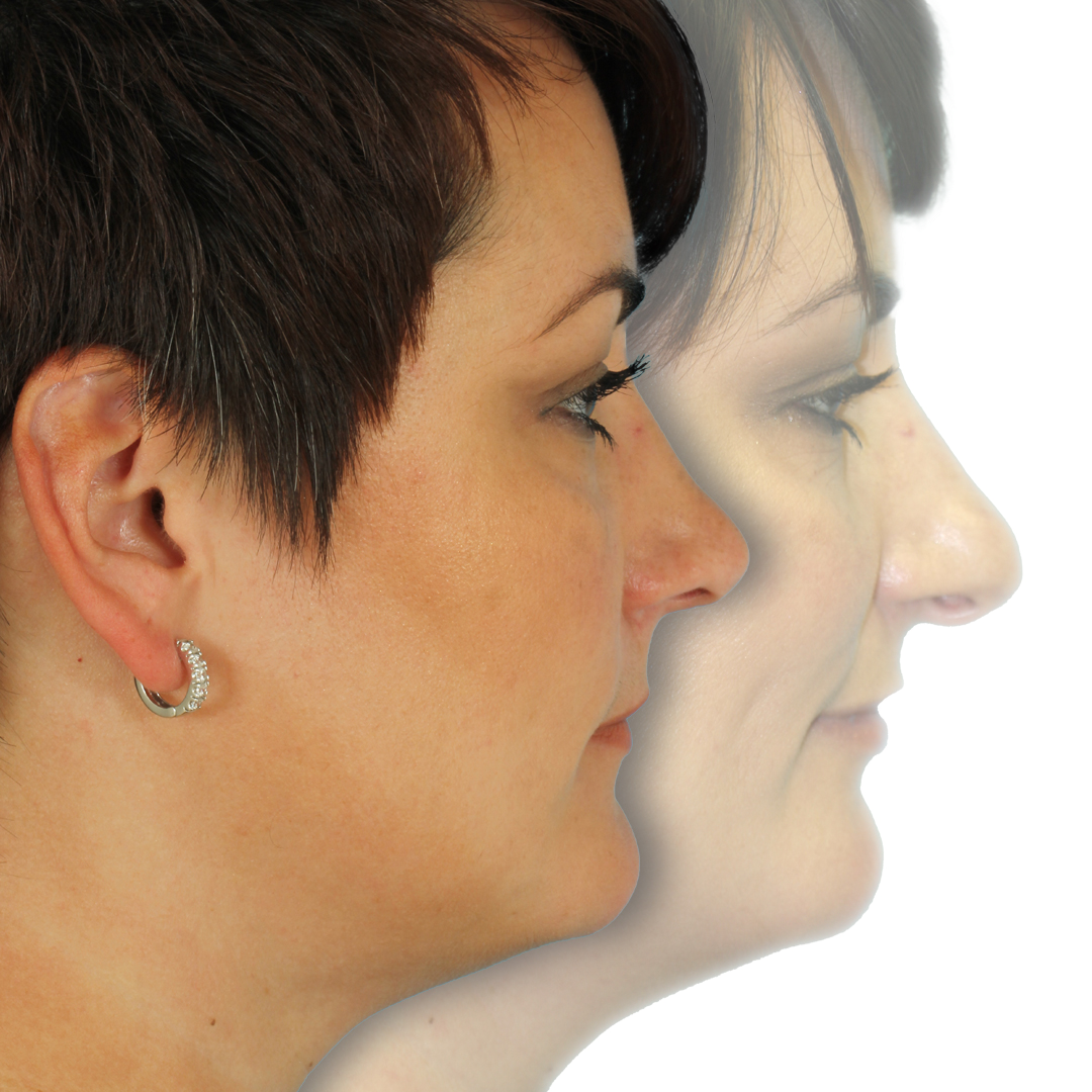 Rhinoplasty before and after photo