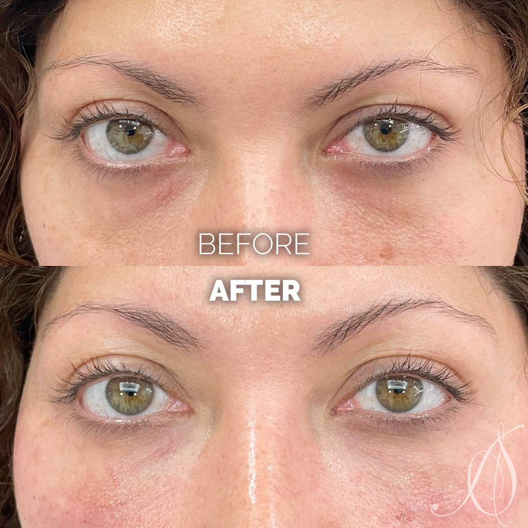 Under eye filler before and after photo