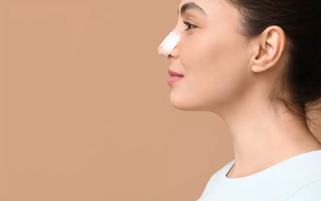 A Subtle Change for a Large Impact. The Closed Rhinoplasty