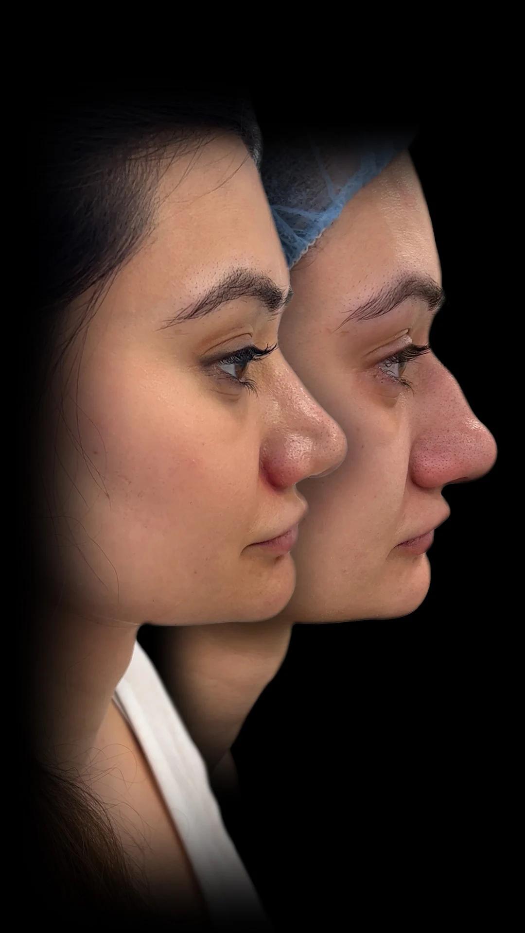 south asian rhinoplasty before and after south asian rhinoplasty before and after