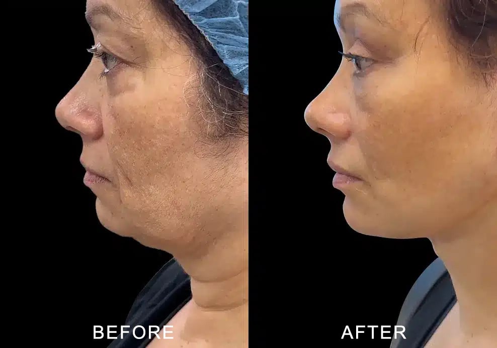 aging face before and after photos by noses and necks nyc in new york ny copy