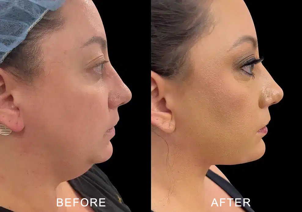 aging face before and after photos by noses and necks nyc in new york ny