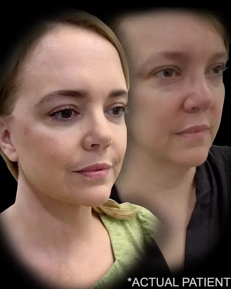 before and after patient with layer facelift