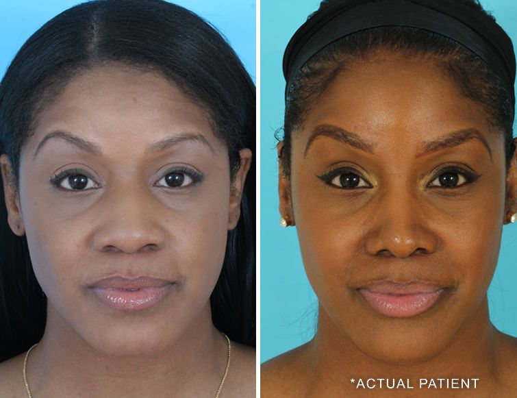 actual patient african american rhinoplasty pictures