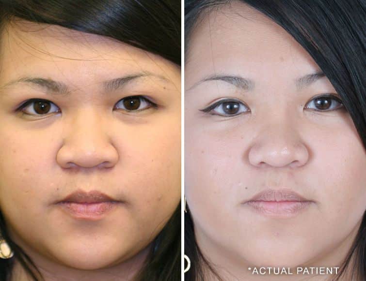 actual patient asian rhinoplasty pictures