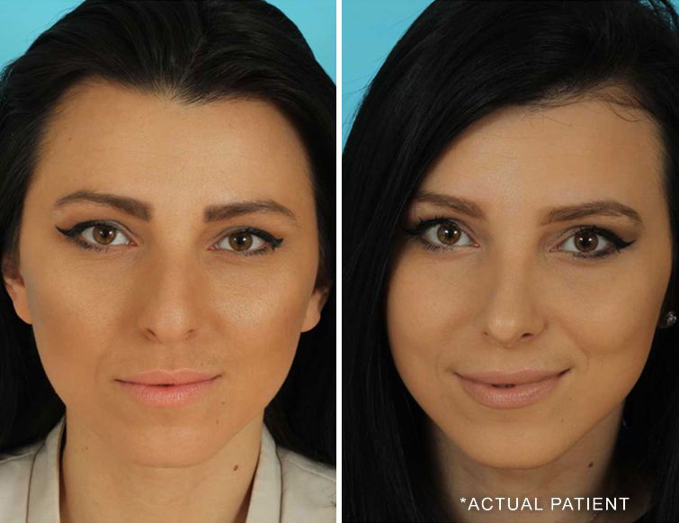 actual patient middle eastern rhinoplasty pictures