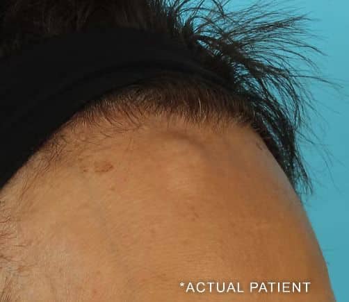 actual patient osteoma before and after copy