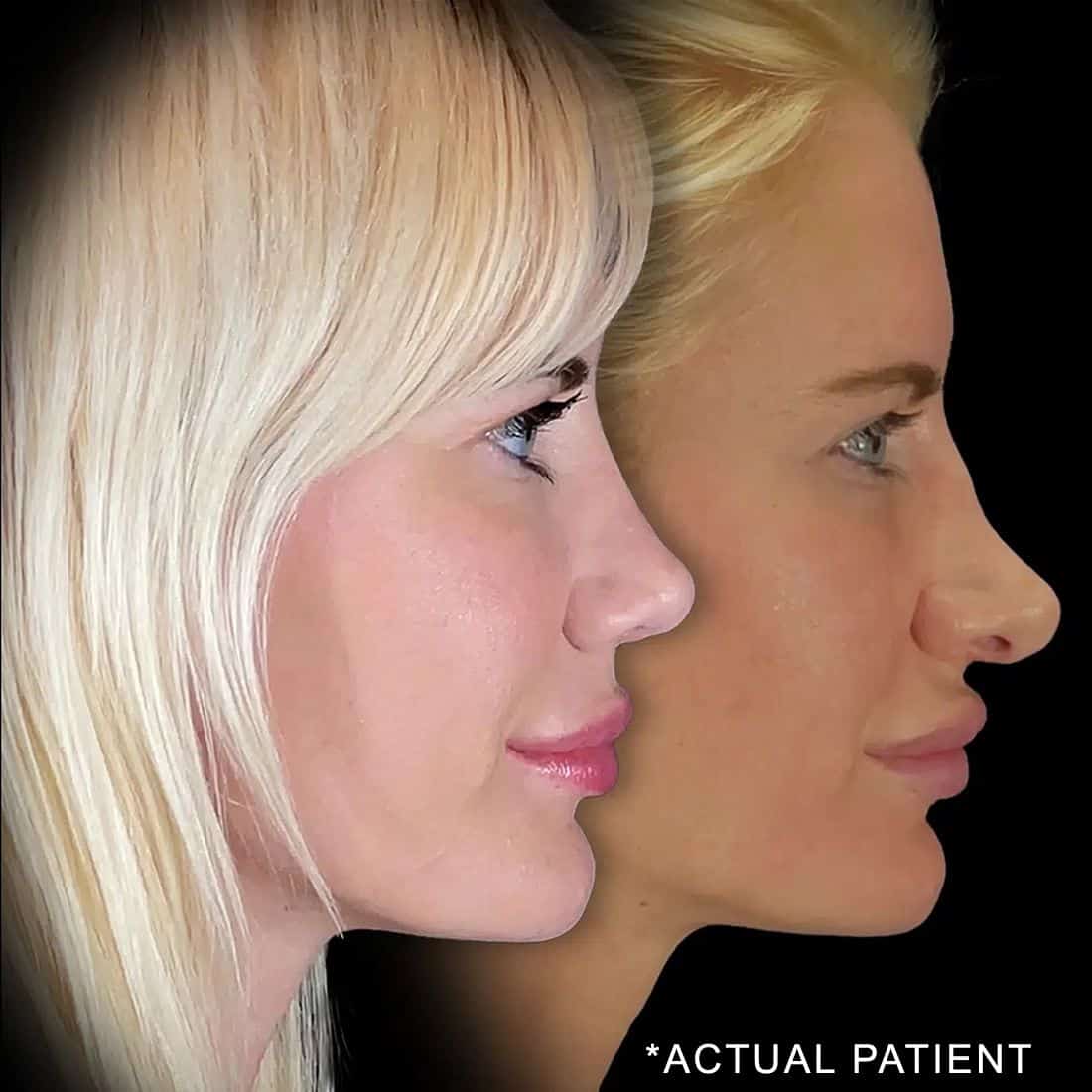 actual patient revision rhinoplasty before an after photo