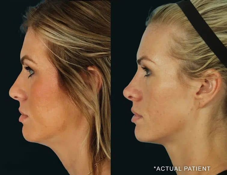 actual patient rhinoplasty before and after photos by noses and necks nyc in new york ny