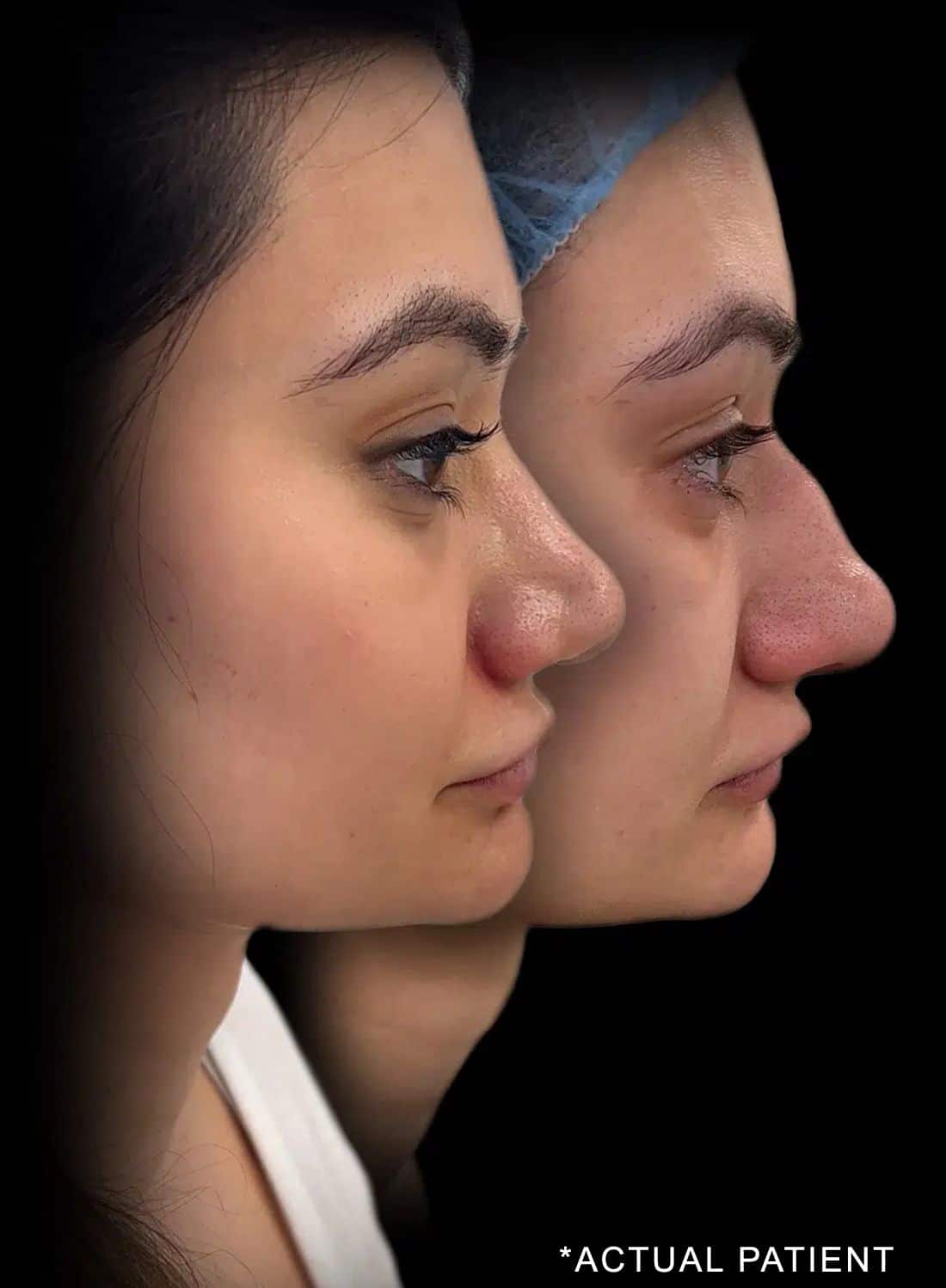 actual patient south asian rhinoplasty before and after
