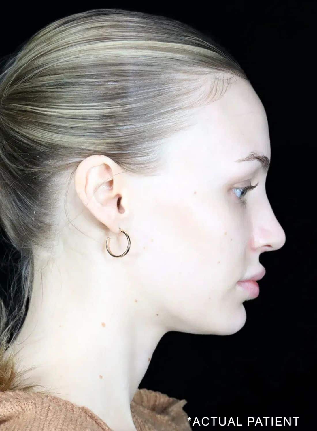 Utrasonic Rhinoplasty in Manhattan, NY | Noses and Necks NYC