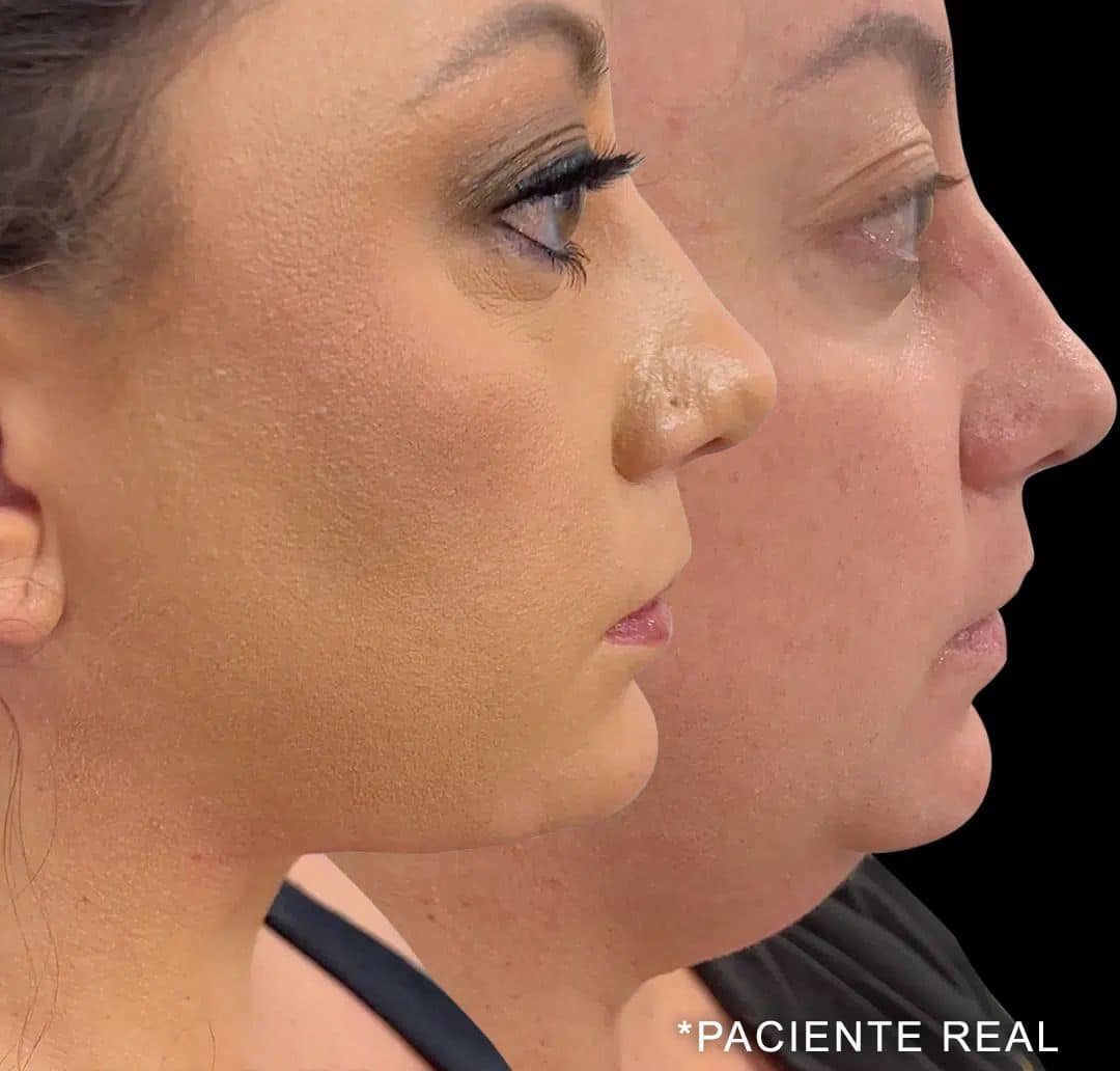 paciente real layer neck lift patient before and after photo