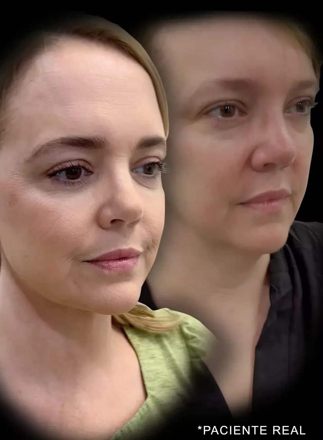 paciente real before and after patient with layer facelift