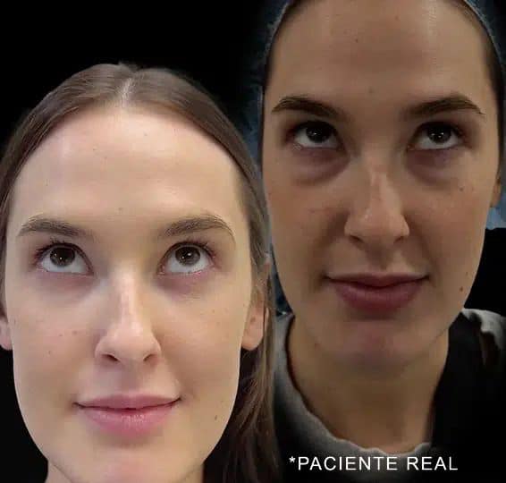 paciente real blepharoplasty before after