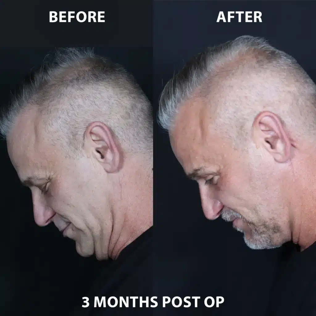 chin down left side view neck lift before and after photos by noses and necks nyc JH