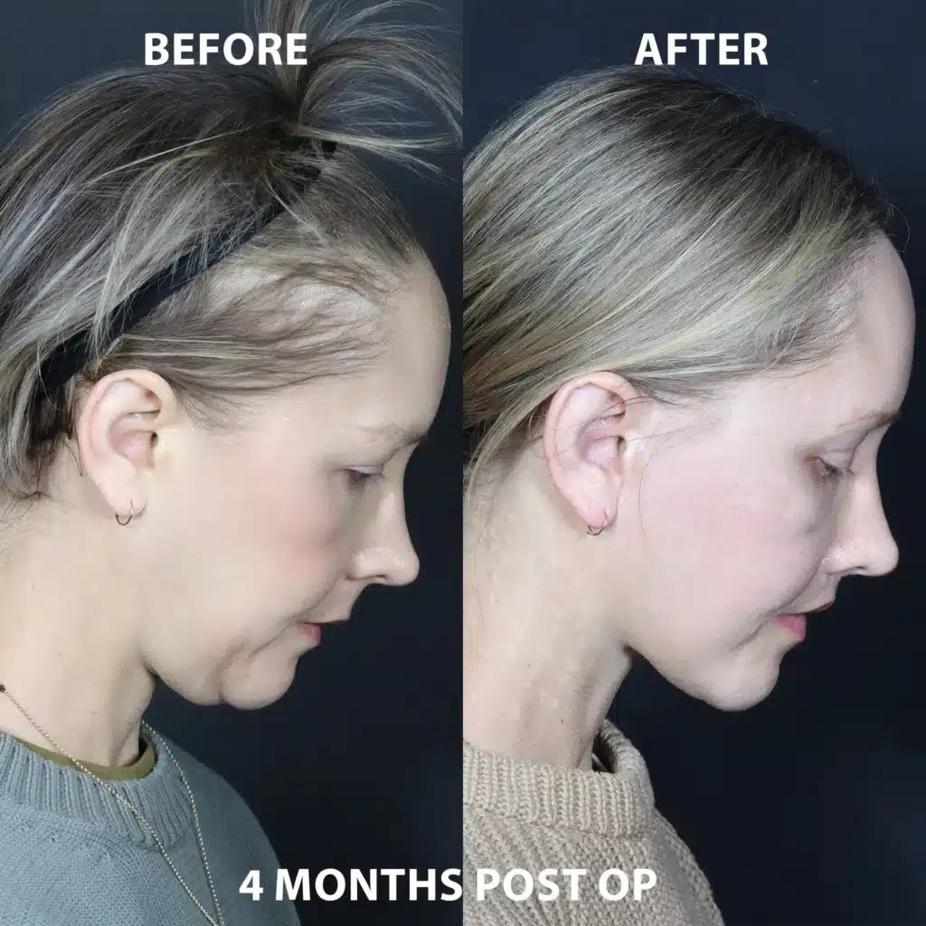 chin down right side view face neck lift before and after photos by noses and necks nyc KP