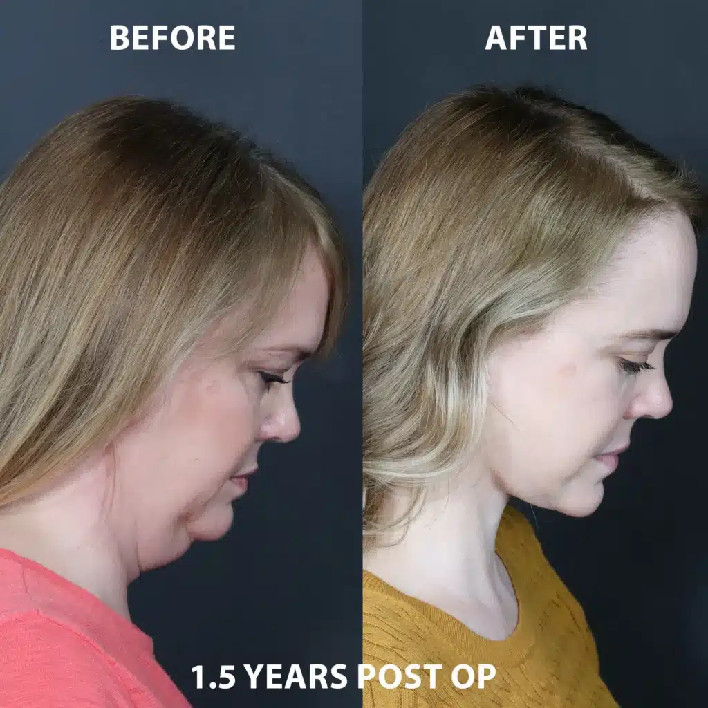 chin down right side view face neck lift before and after photos by noses and necks nyc MB