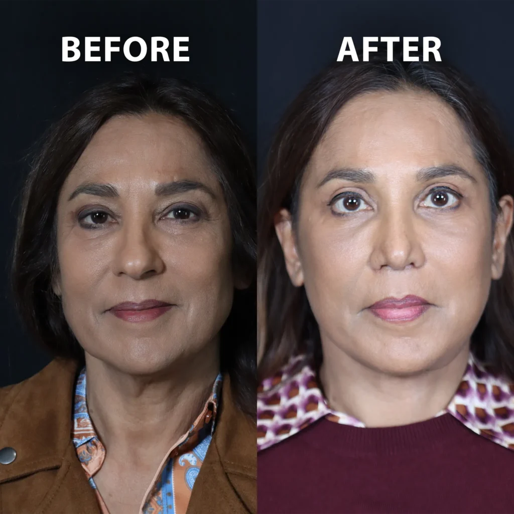 front view blepharoplasty before and after photos by noses and necks nyc NP