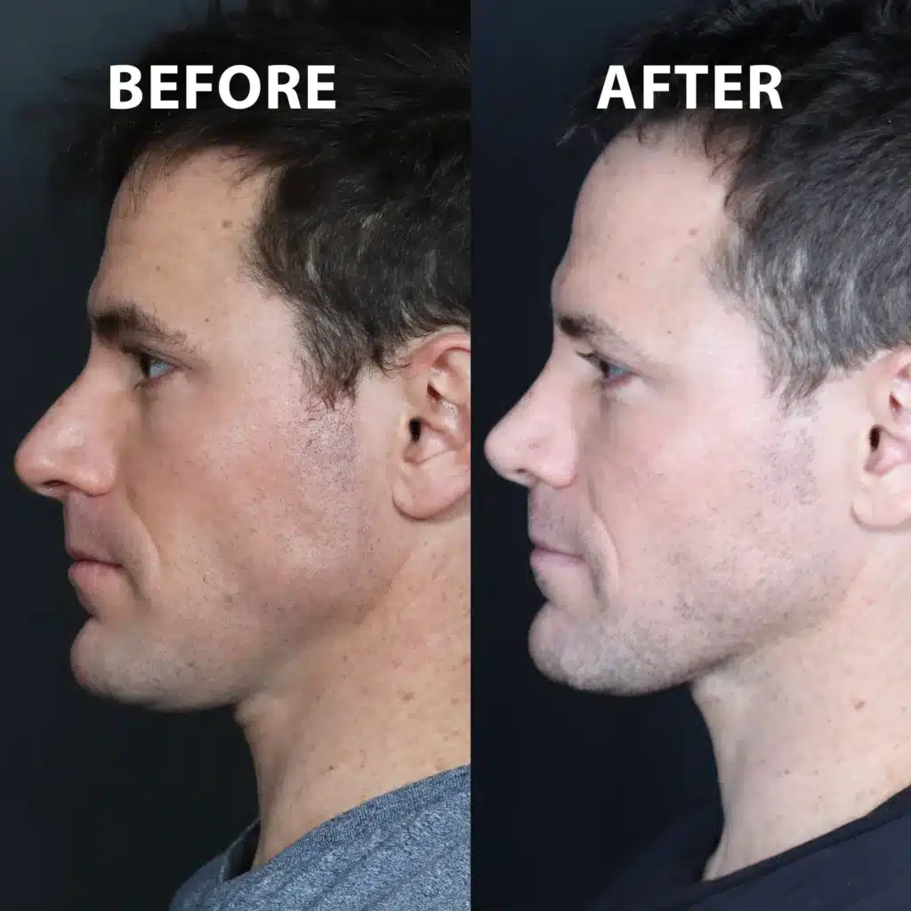 left side view rhinoplasty before and after photos by noses and necks nyc NM