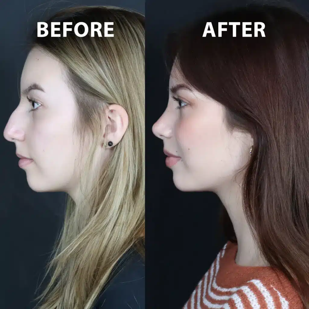 left side view rhinoplasty before and after photos by noses and necks nyc NT
