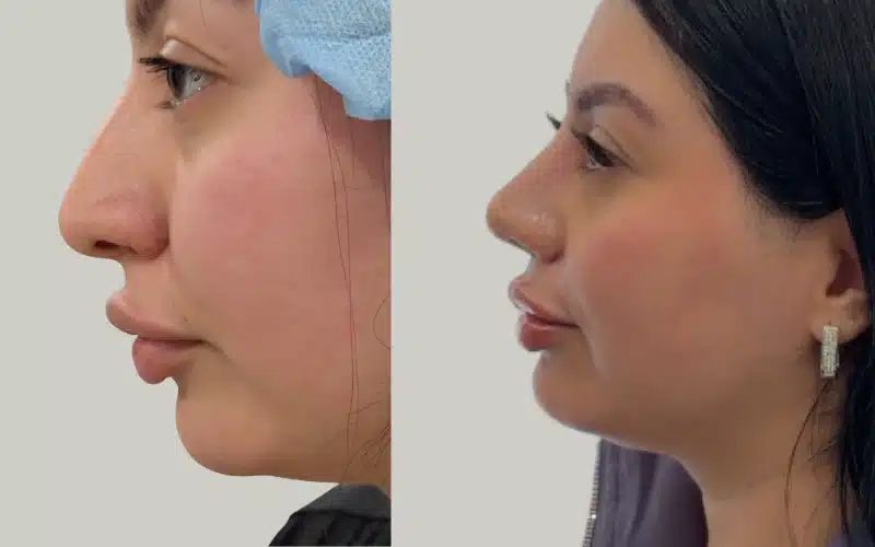 rhinoplasty before and after results DM RE