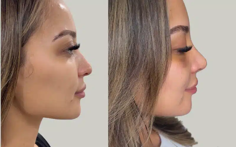 rhinoplasty before and after results DV RE