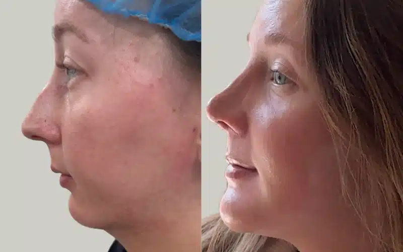 rhinoplasty before and after results GoinsRE