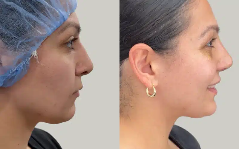 rhinoplasty before and after results JR RE