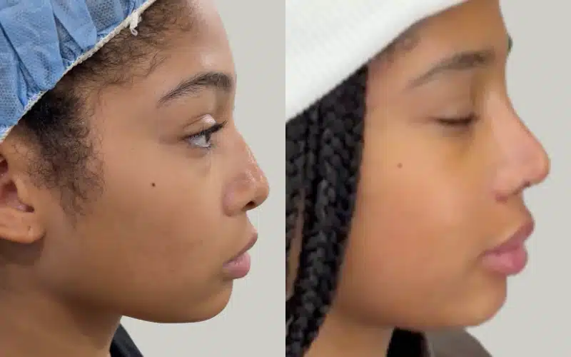 rhinoplasty before and after results KM RE