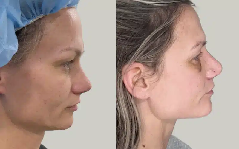 rhinoplasty before and after results KS RE