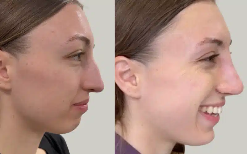 rhinoplasty before and after results MT RE