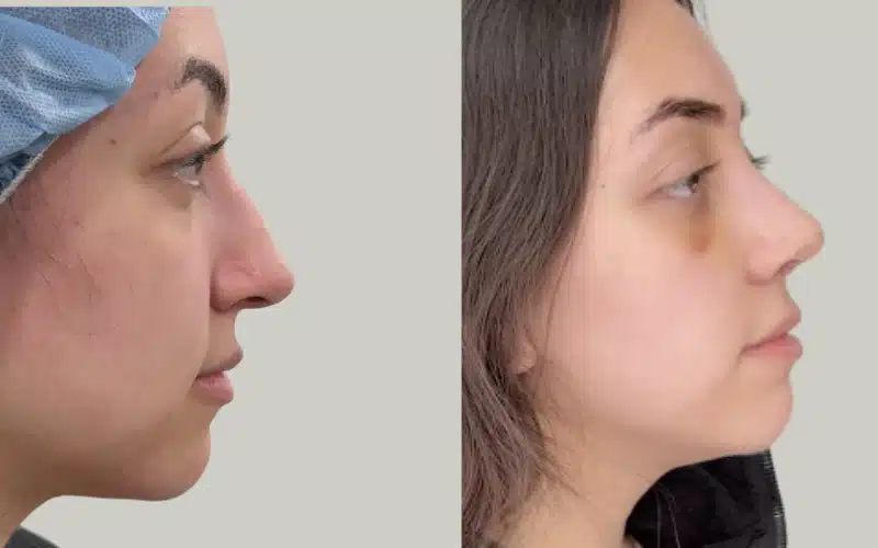 rhinoplasty before and after results NG RE