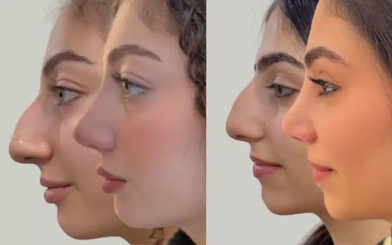 rhinoplasty before and after results OMARTWINS RE