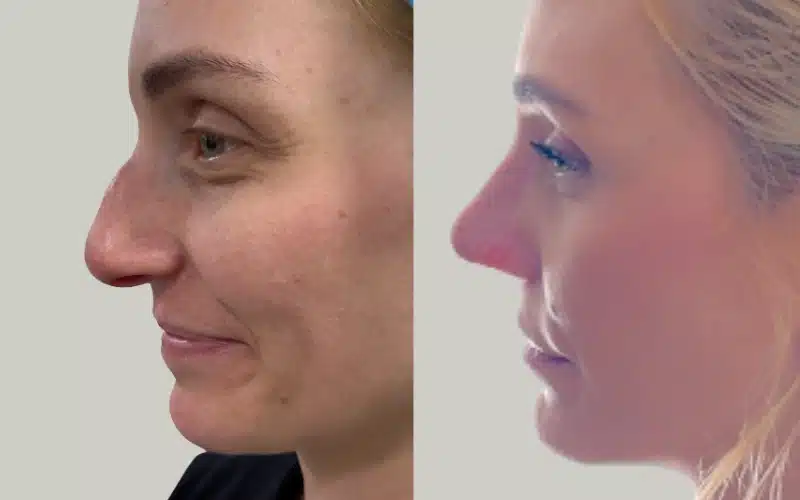 rhinoplasty before and after results TB RE