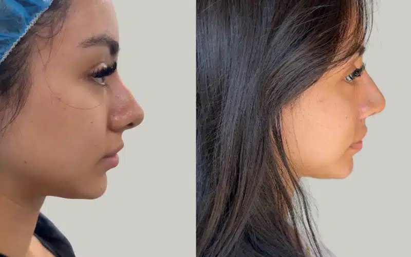 rhinoplasty before and after results VM RE