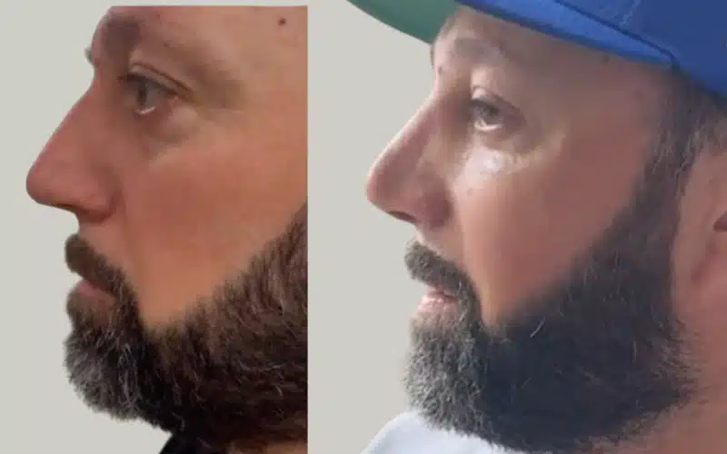 rhinoplasty before and after results storrito story ()