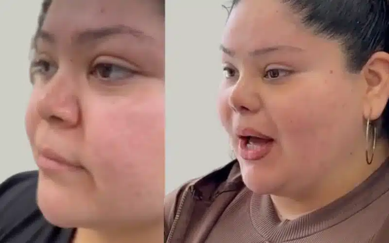 rhinoplasty before and after results storrito story ()