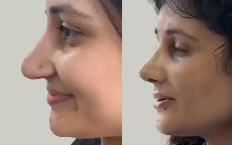 rhinoplasty before and after results storrito story ()