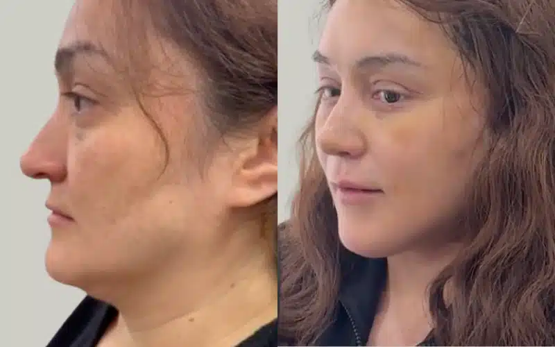 rhinoplasty before and after results storrito story ()