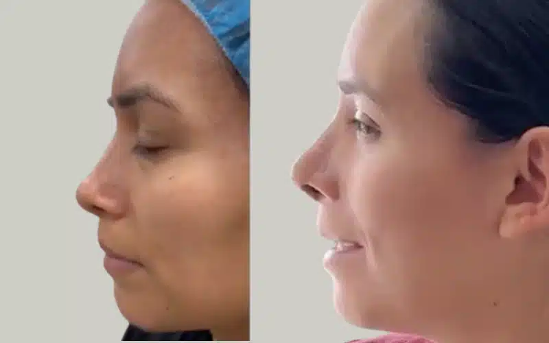 rhinoplasty before and after results storrito story ()