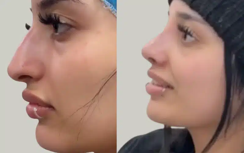 rhinoplasty before and after results storrito story ()