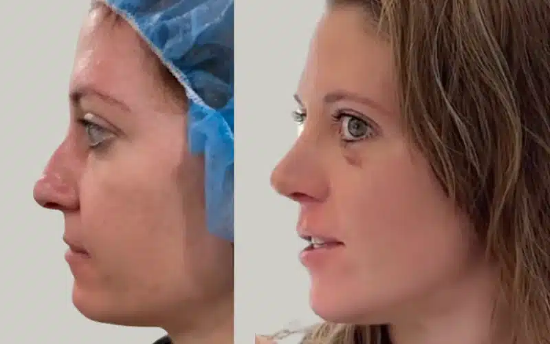rhinoplasty before and after results storrito story ()