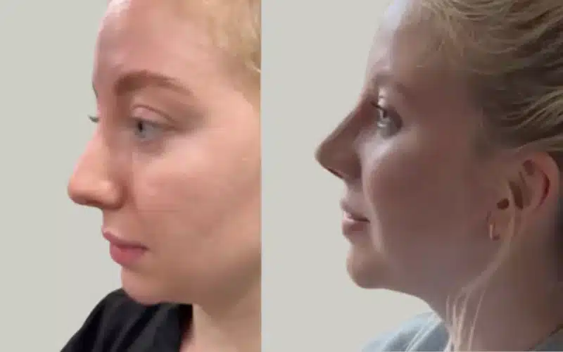rhinoplasty before and after results storrito story ()