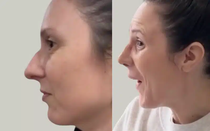 rhinoplasty before and after results storrito story ()