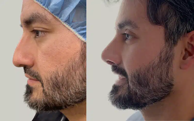rhinoplasty before and after results washington audio