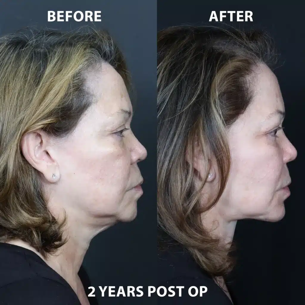 right side view face neck lift before and after photos by noses and necks nyc MM
