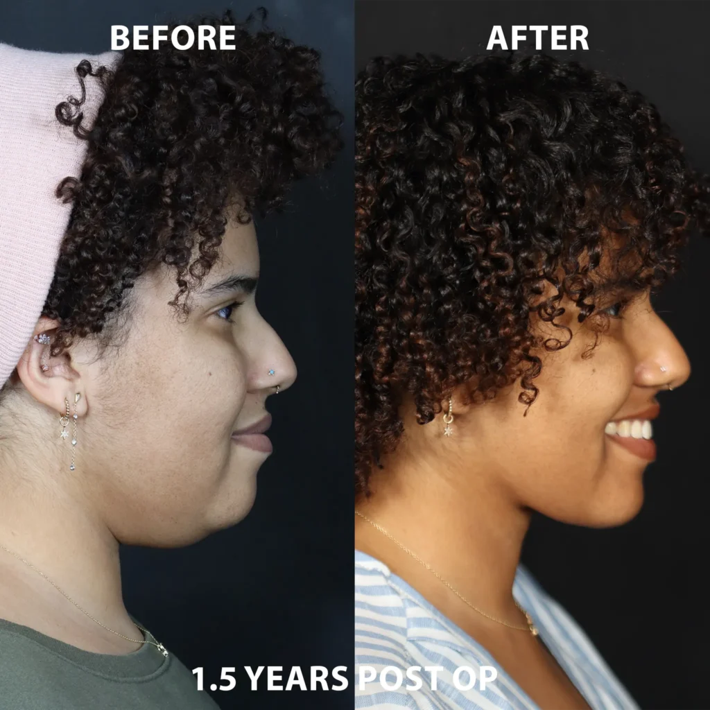 right side view neck lift before and after photos by noses and necks nyc LM