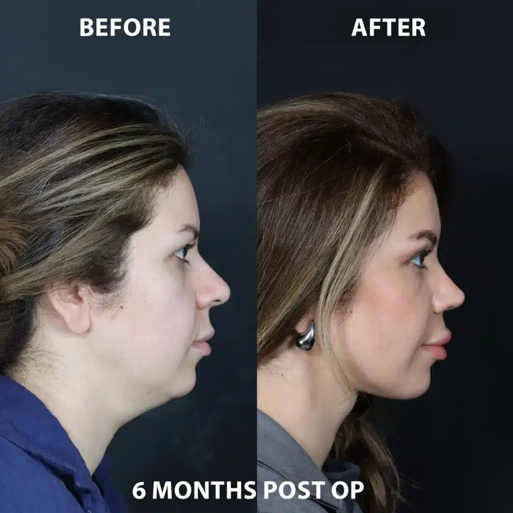 right side view neck lift before and after photos by noses and necks nyc NY