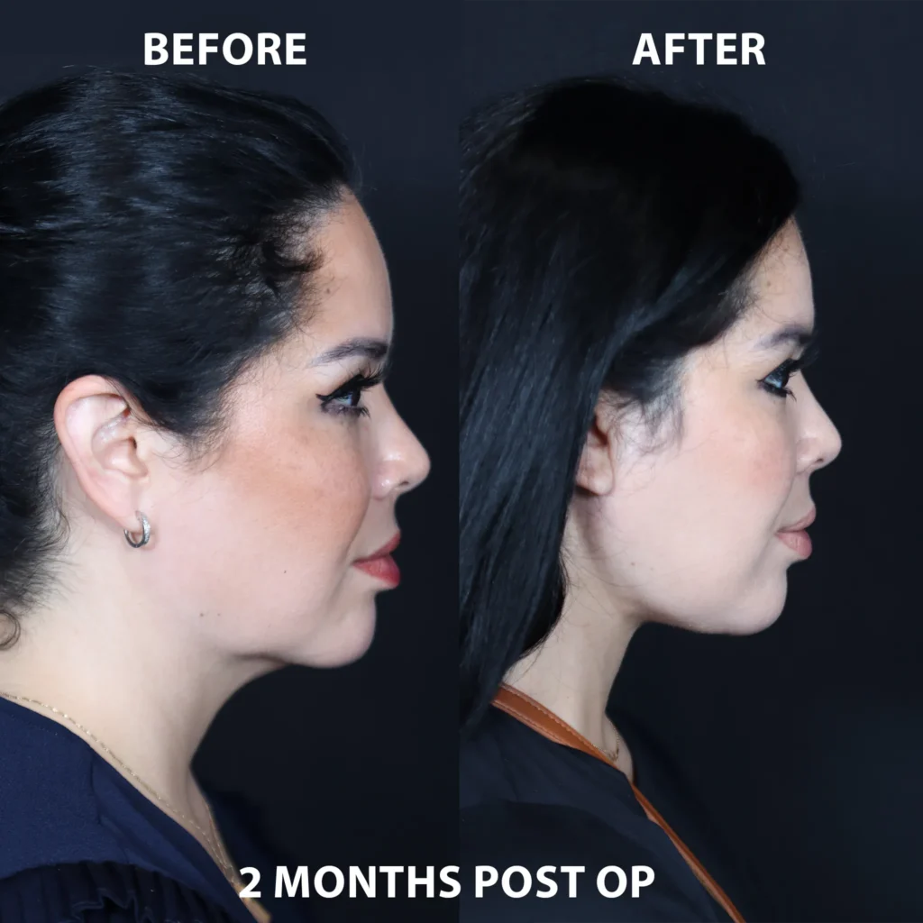 right side view neck lift before and after photos by noses and necks nyc RR