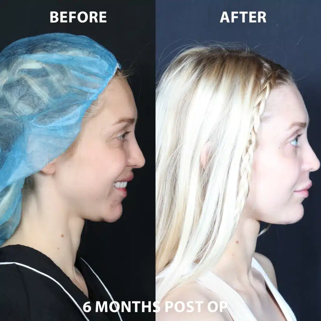 right side view neck lift before and after photos by noses and necks nyc SH